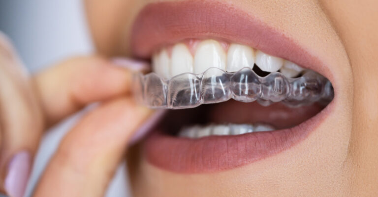 invisalign em montes claros